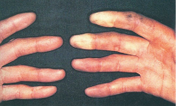 Síndrome de Vibración Mano Brazo (dedo blanco)