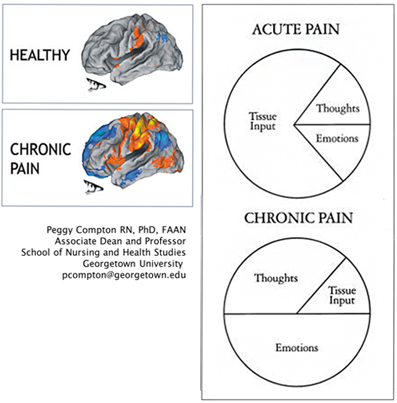 These images depict acute, healthy pain in the brain that contains input from tissues and then a smaller fraction painful  thoughts and emotions, and then a brain with chronic pain, which covers half being due to emotions, and greater than one third to do with thoughts, and then a small percentage due to tissue input