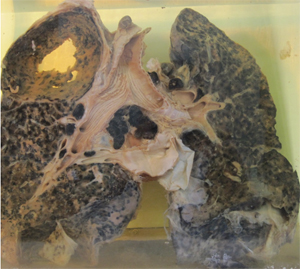 A picture of a preserved set of lungs covered with black damage from Silica